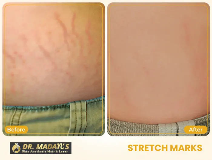 Stretch marks before and after result 10 at Dr Madan Aesthetics